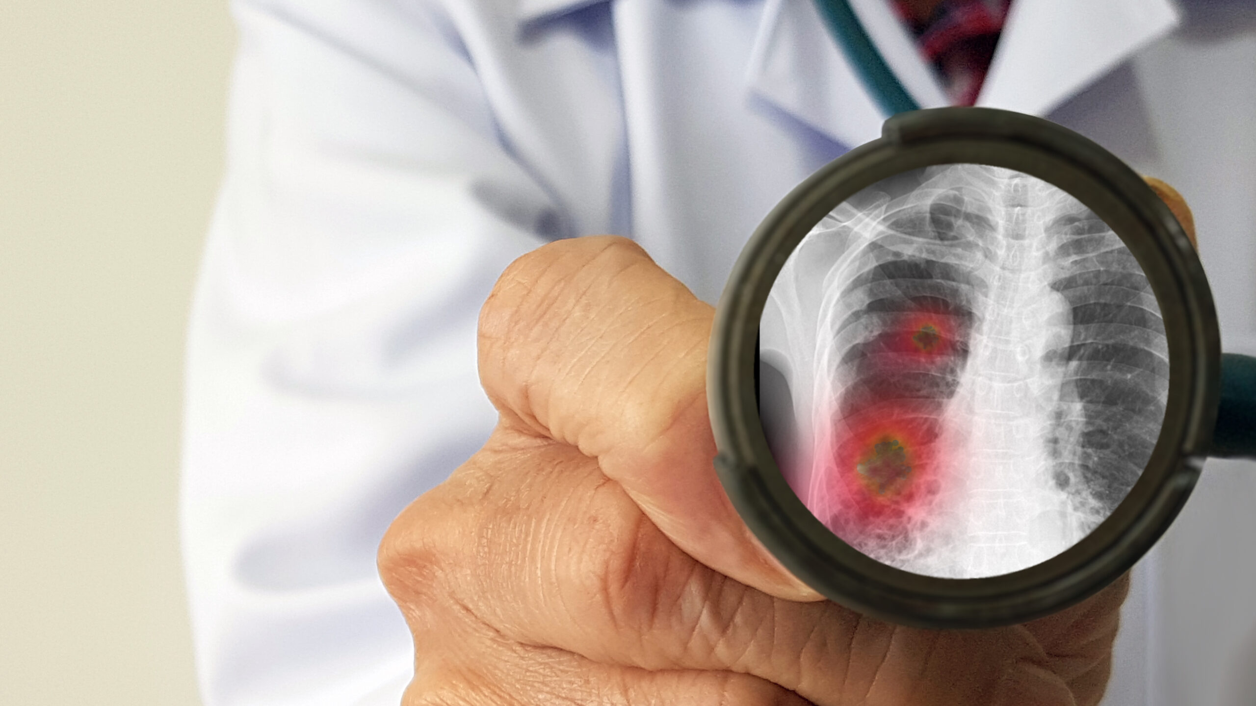 Ventilator-Associated Pneumonia Ceu